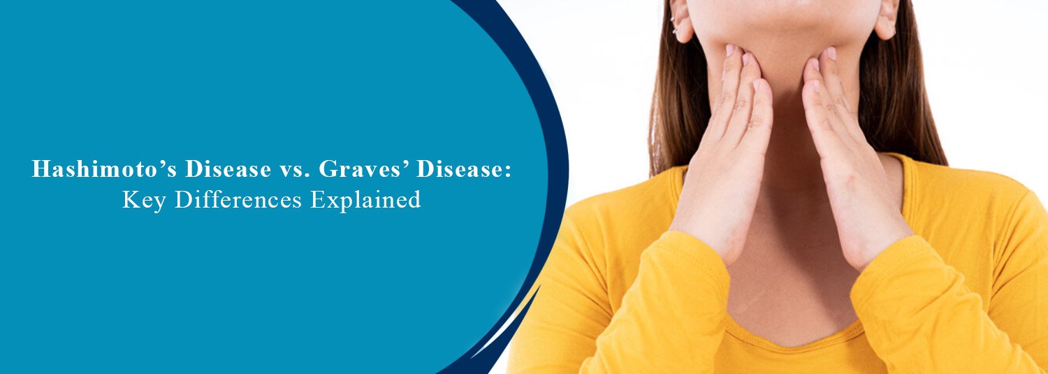 Hashimoto’s Disease vs. Graves’ Disease